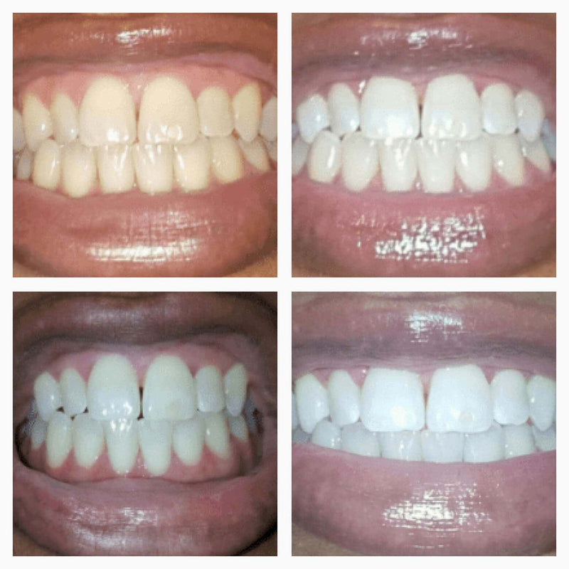 SmileFitPro™ Teeth Whitening Serum