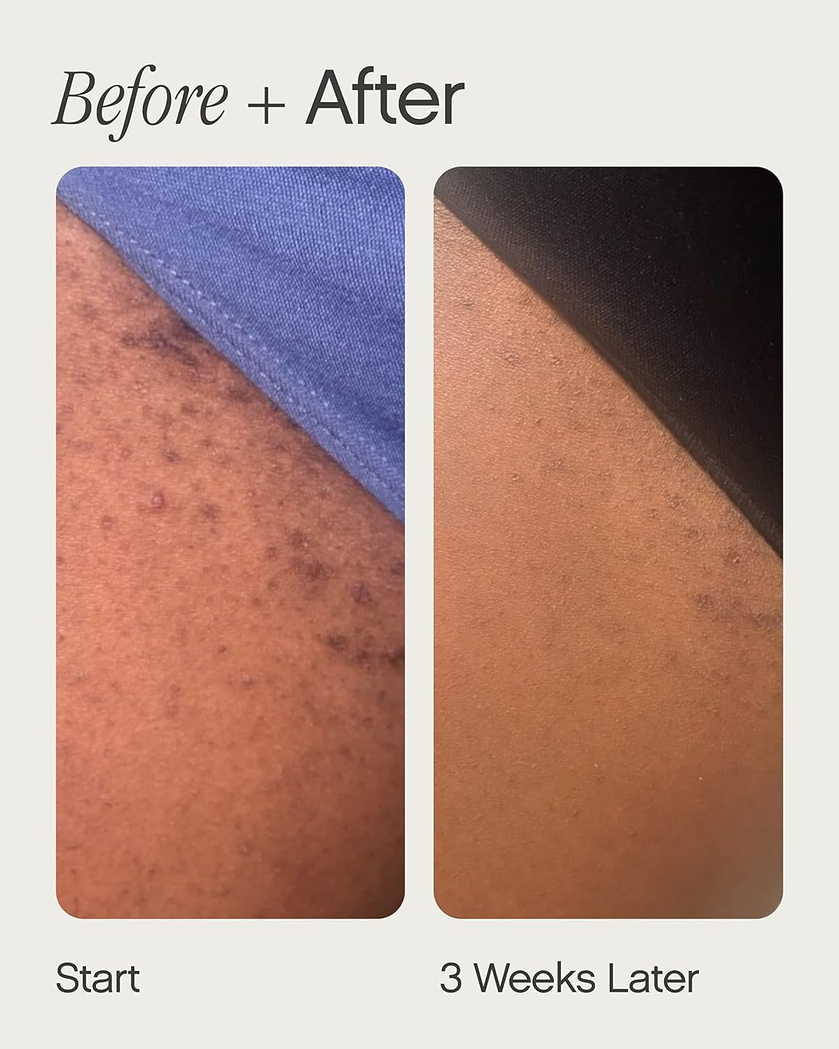 GlideClear™ Ingrown Hair Solution