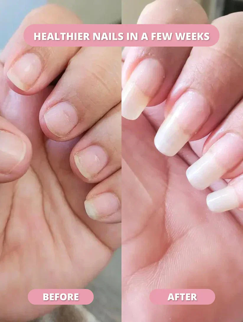 Nailixir™ Nail Growth Pen (75% OFF TODAY ONLY)